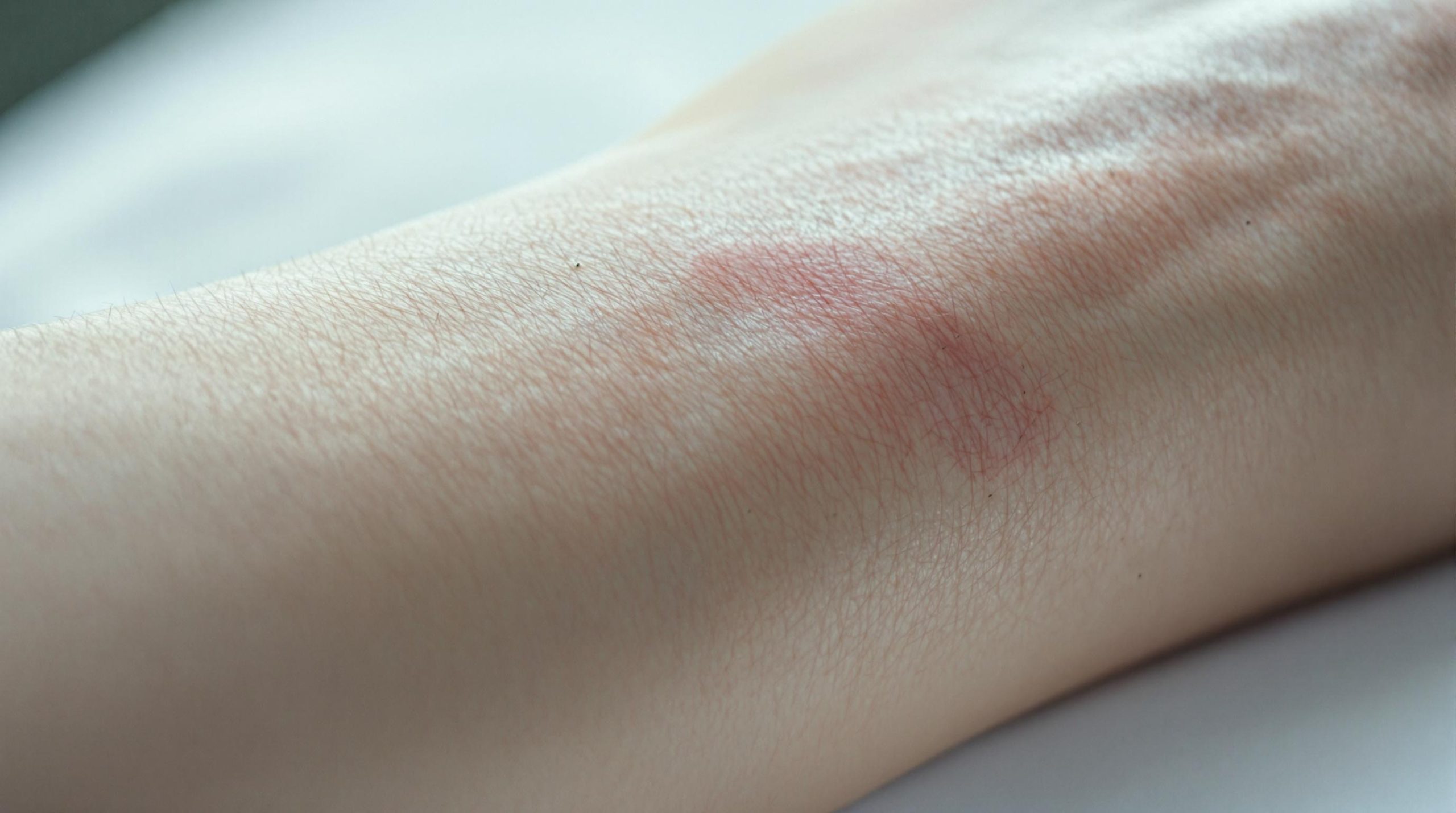 Cicatrice qui fait mal : causes, symptômes et solutions - Espace Lifestyle