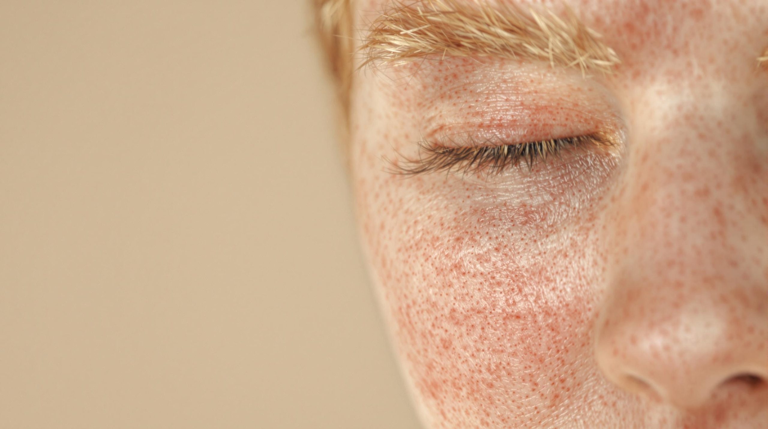 Peau sèche et rougeurs du visage : causes et solutions - Espace Lifestyle